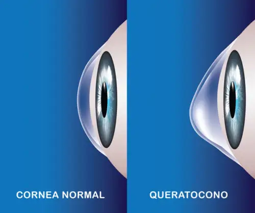 queratocono-normal-cornea-500×418-1